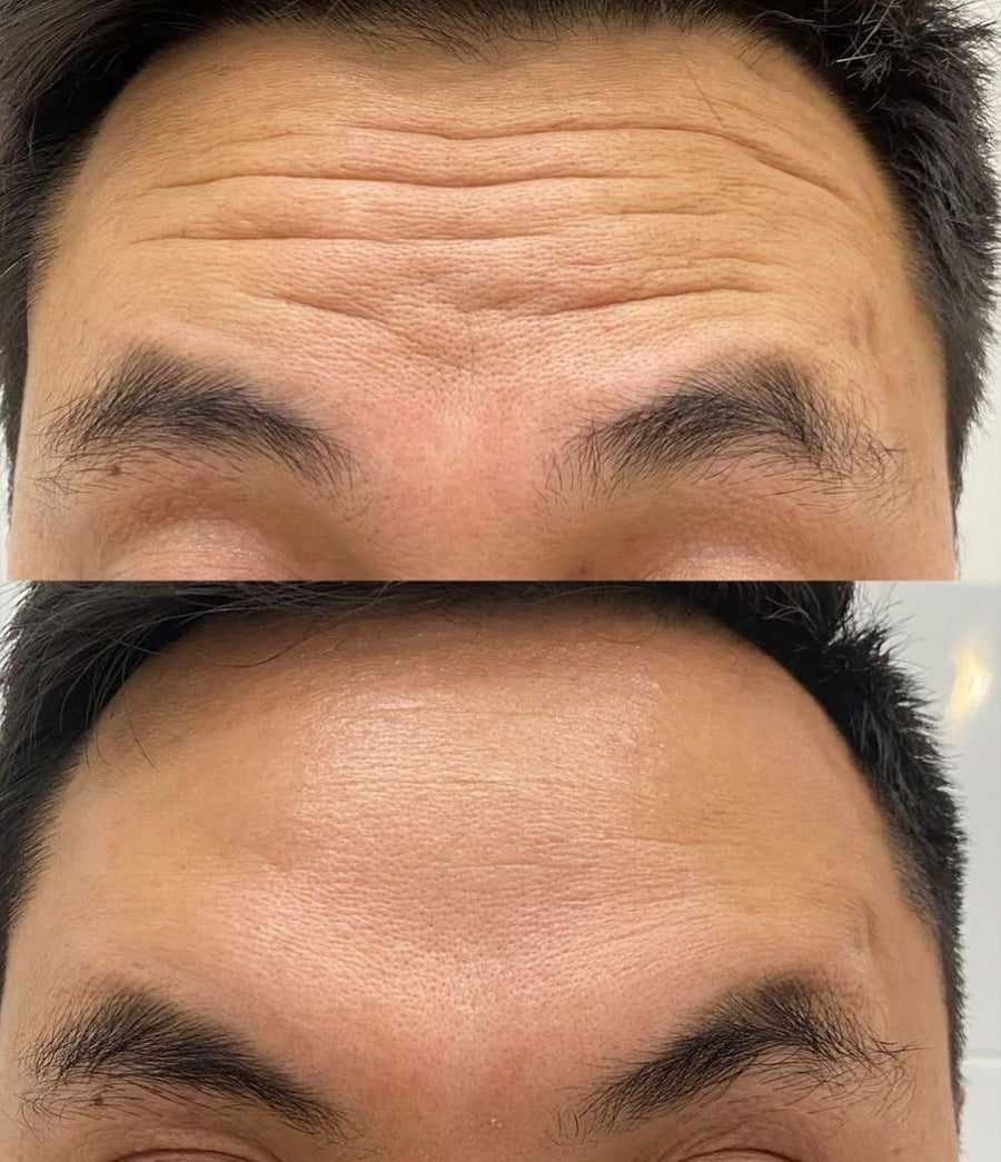 Les rides horizontales du front